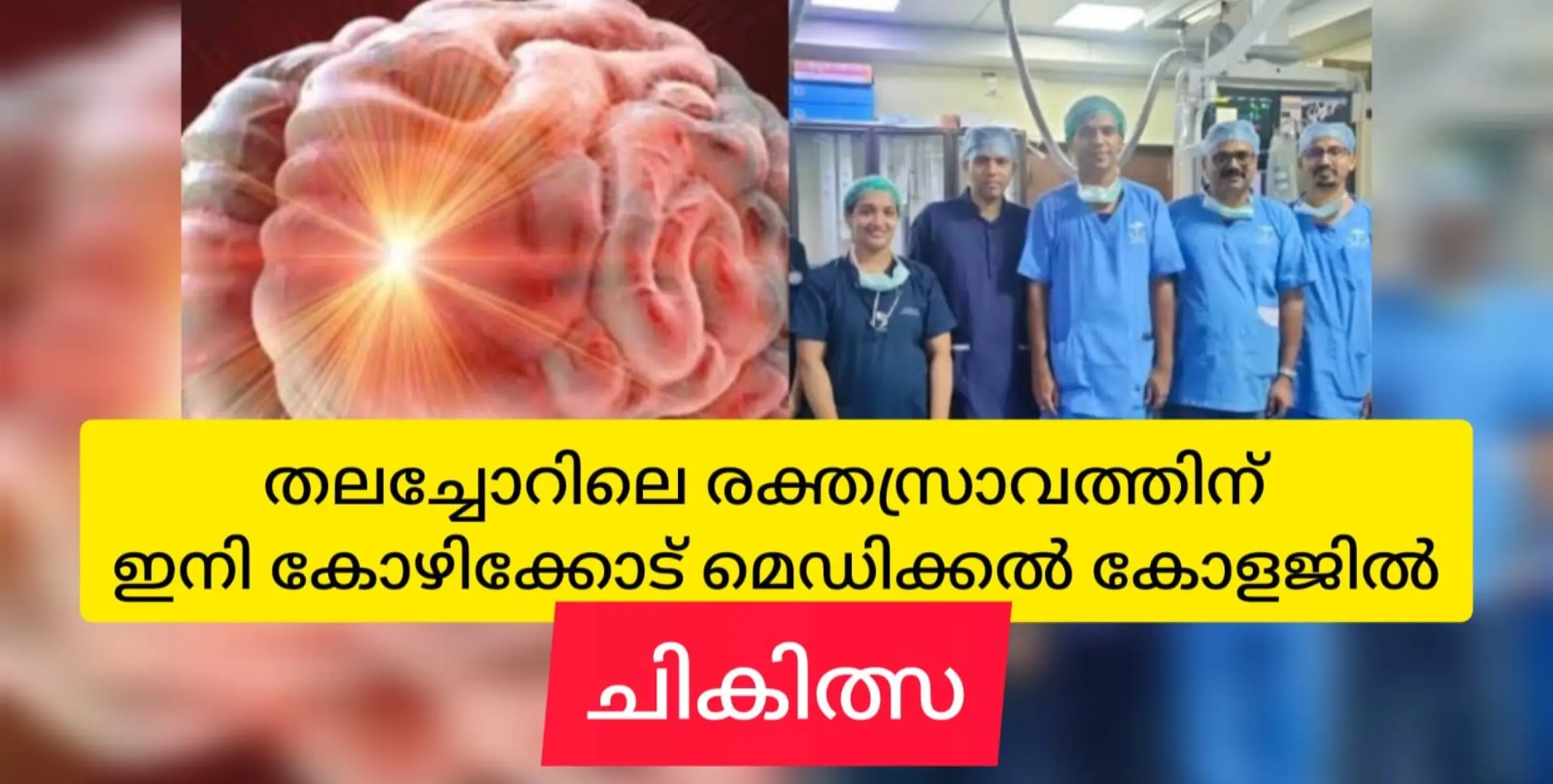 തലച്ചോറിലെ രക്ത സ്രാവത്തിന് ഇനി കോഴിക്കോട് മെഡിക്കൽ കോളജിൽ സൗകര്യം.