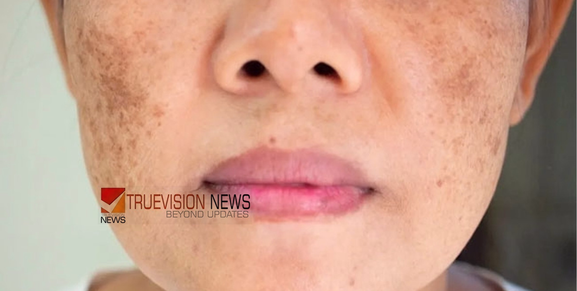 #health | മുഖത്ത് കറുത്ത പാടുകൾ ഉണ്ടോ? വിഷമിക്കേണ്ട, അകറ്റാൻ പൊടികൈകൾ ഇതാ