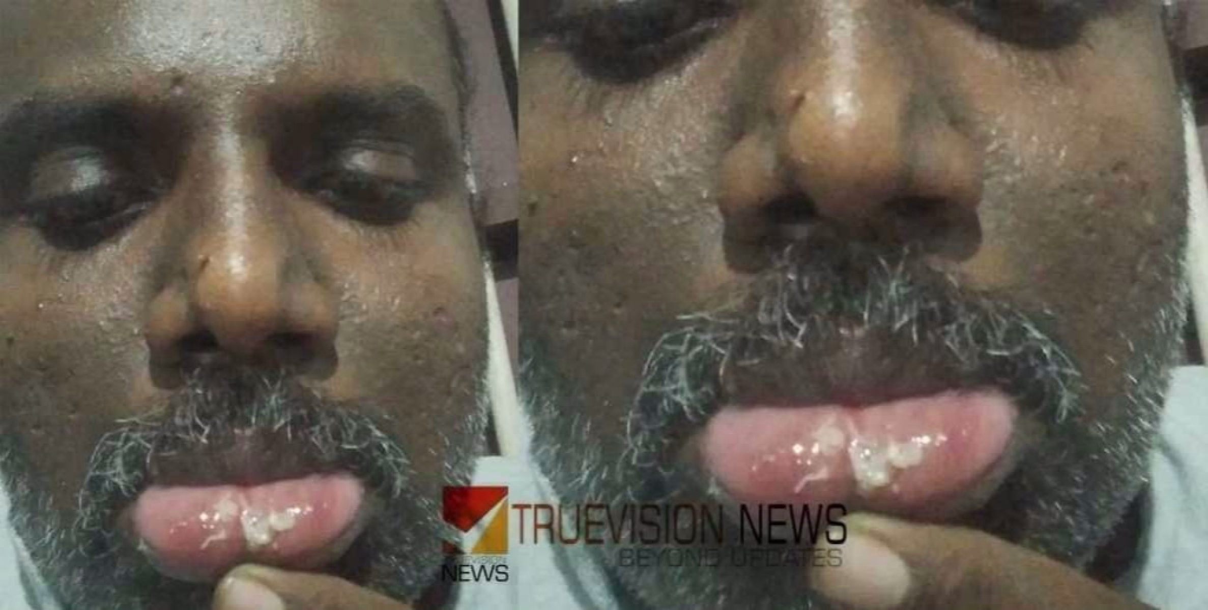  അഴിയൂരില്‍ മദ്യപാനം എതിര്‍ത്ത യുവാവിനെ ക്രൂരമായി മര്‍ദ്ദിച്ച സംഭവം; അഞ്ച് പേര്‍ക്കെതിരെ കേസെടുത്ത് ചോമ്പാല പോലീസ് 